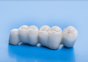 Dental Bridges
