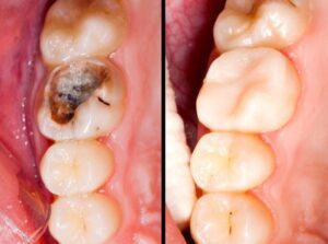 Fillings