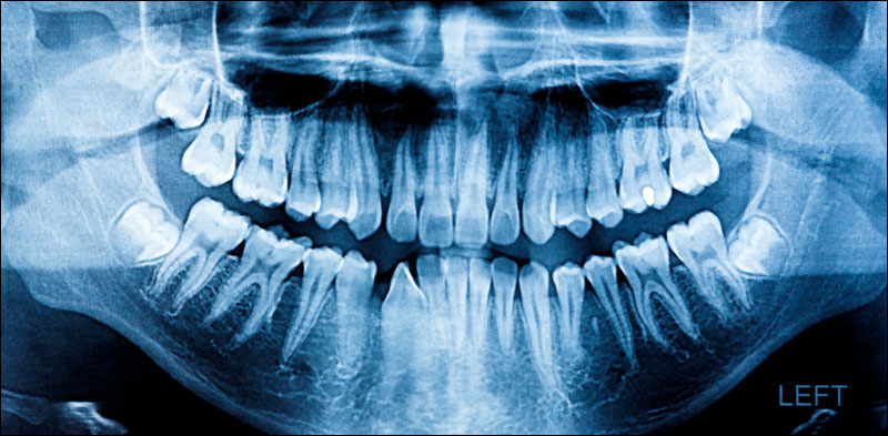 Dental X Rays