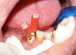 Root Canal Treatments