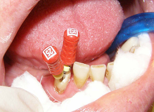 The Direction Of The Two Root Canals