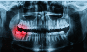 Dental Xrays