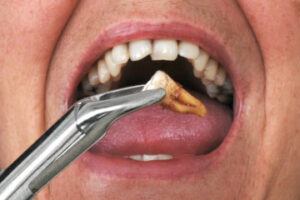Extractions