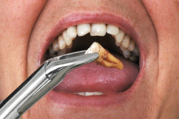 Tooth Extraction 1